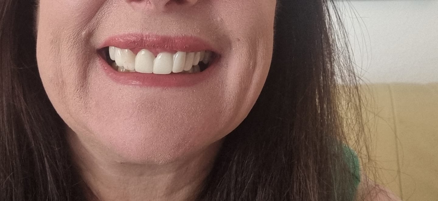 Snap On False Teeth Upper + Lower Dental Instant Veneers Dentures Tooth Cover White | Natural Look photo review